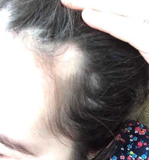 Alopecia Areata Alopecia Areata