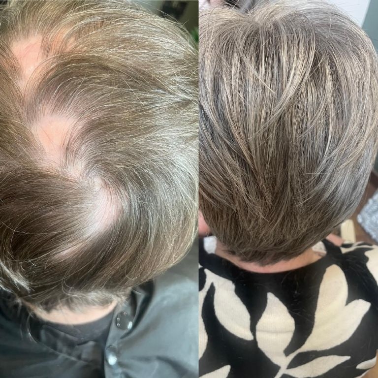 Hair Loss Clinic NI | Hair Loss | Bridgeen King Hair Loss Clinic NI | Hair Loss | Bridgeen King